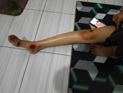 Mahasiswi Terjatuh di Lubang Jalan, Warga Desak DPUPR Banten Perbaiki Jalan Rusak di Serang-Pandeglang